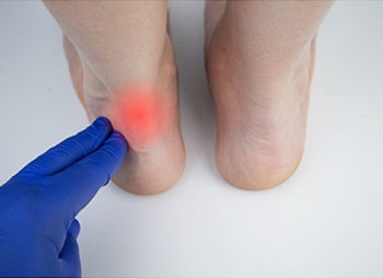 Signs and Symptoms of Achilles Tendonitis