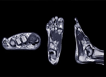 Sprained Ankle or Something Worse? When to Get an MRI for Chronic Ankle Pain