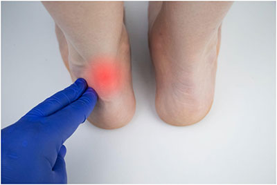 Signs and Symptoms of Achilles Tendonitis