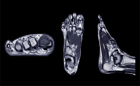 Sprained Ankle or Something Worse? When to Get an MRI for Chronic Ankle Pain