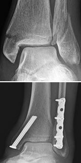 Broken Bones (fracture)