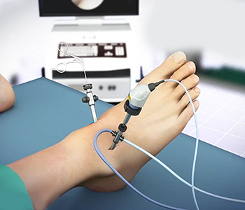 Minimally Invasive Foot/Ankle Surgery