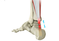 Achilles Rupture