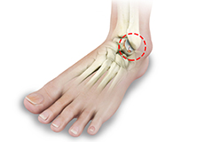 Ankle Arthritis