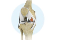 Cartilage Injuries 