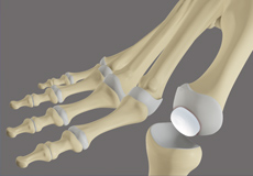 Great Toe Replacement with Synthetic Cartilage