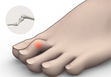 Hammer Toe Correction