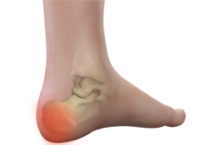 Heel Pain