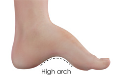High Arch Foot