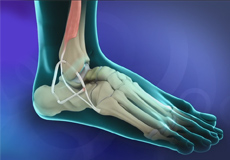 Lateral Ankle Ligament Reconstruction