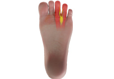 Morton's Neuroma