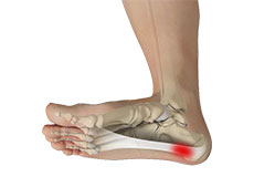 Plantar Fasciitis