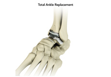 Total Ankle Replacement